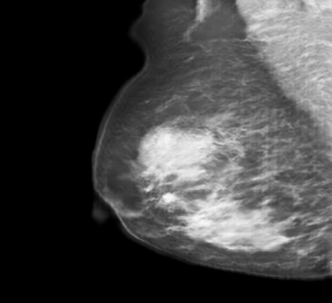 Generated Nodule Image